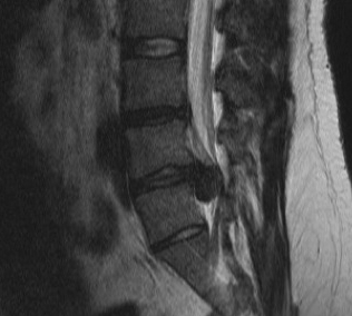 Cauda Equina MRI